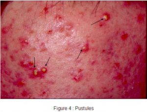 Pustules
