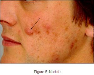 Nodule
