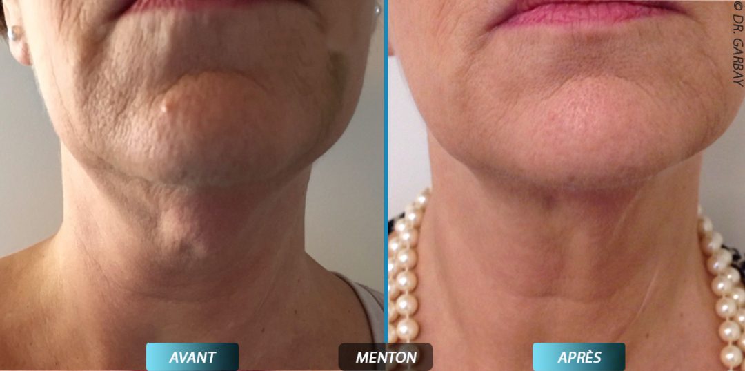Double menton Dr Vincent Cante Dermatologue Bordeaux