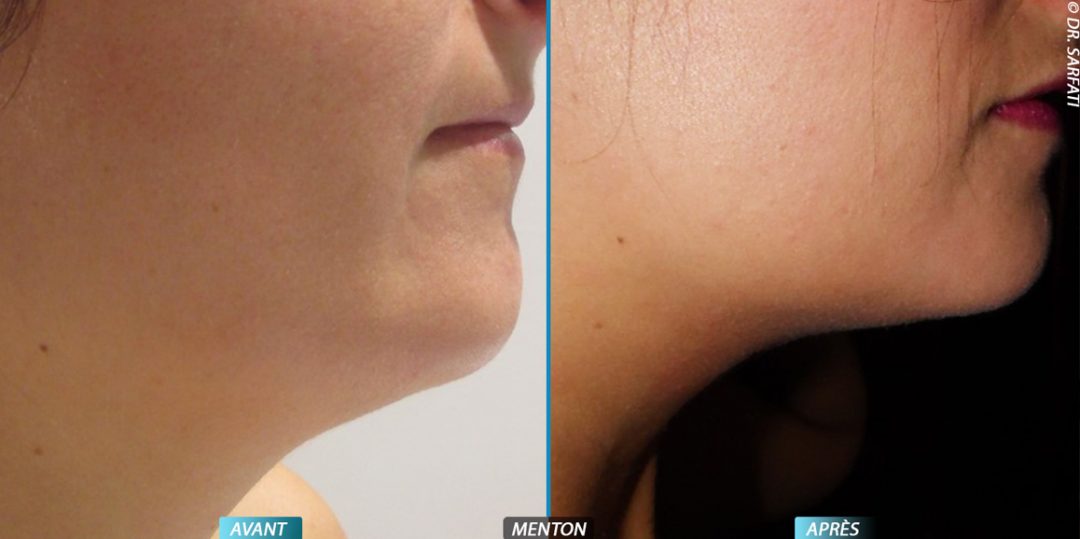 Docteur Vincent Cante - Dermatologue Esthétique - Cryolipolyse - Laser