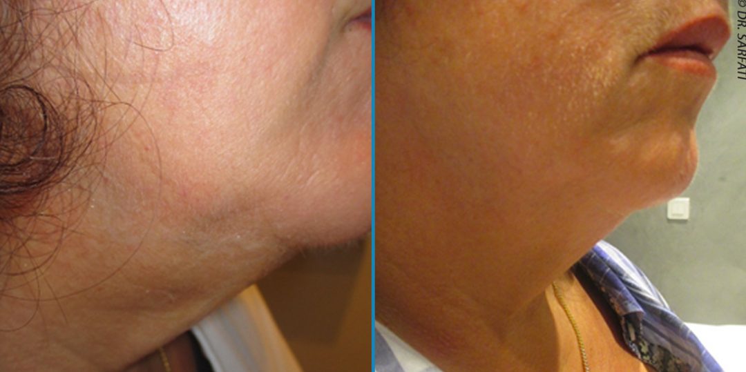 Double menton Dr Vincent Cante Dermatologue Bordeaux