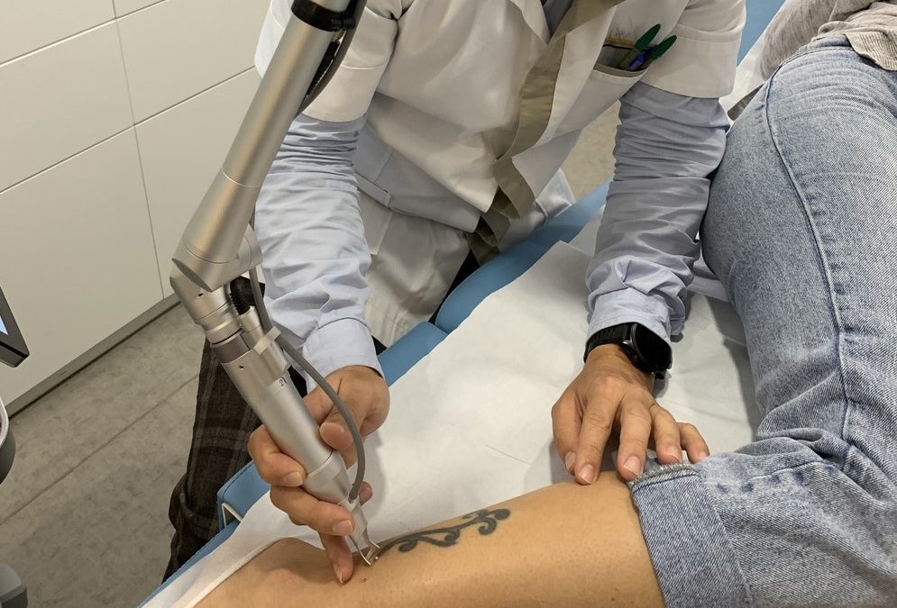 Tout ce que vous devez savoir sur le détatouage laser