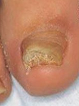 Spécialiste Traitement Mycoses Des Ongles Dr Cante Bordeaux