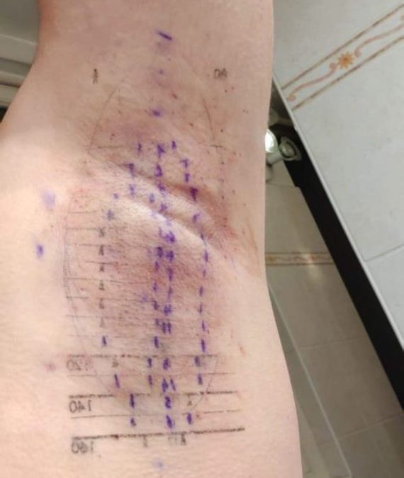 Avis d’un patient de Bordeaux sur le traitement miraDry