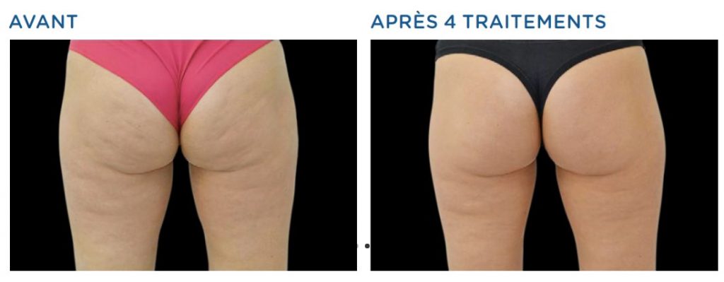 Emtone Bordeaux, technique non invasive anti cellulite sur tous les endroits du corps