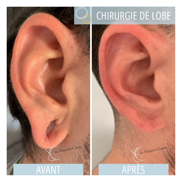 Chirurgie lobe d'oreille