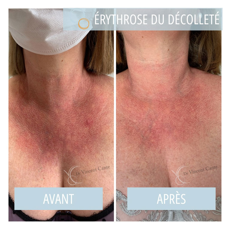 Erythrose du décolleté