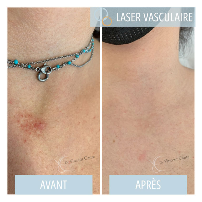 Laser vasculaire