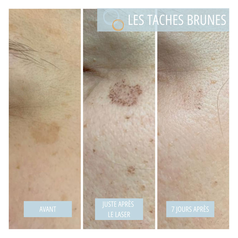 Tâches brunes