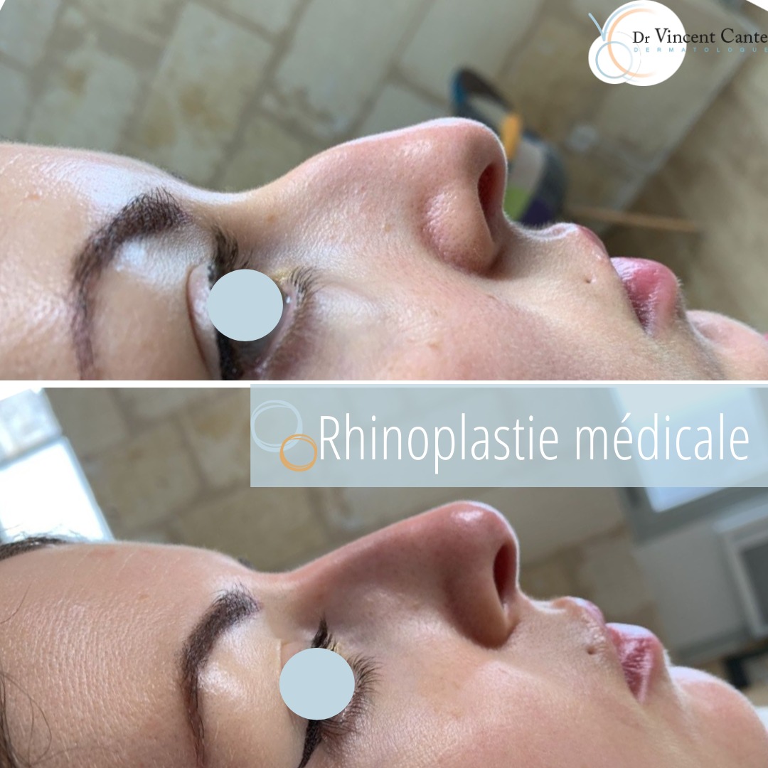 Rhinoplastie médical